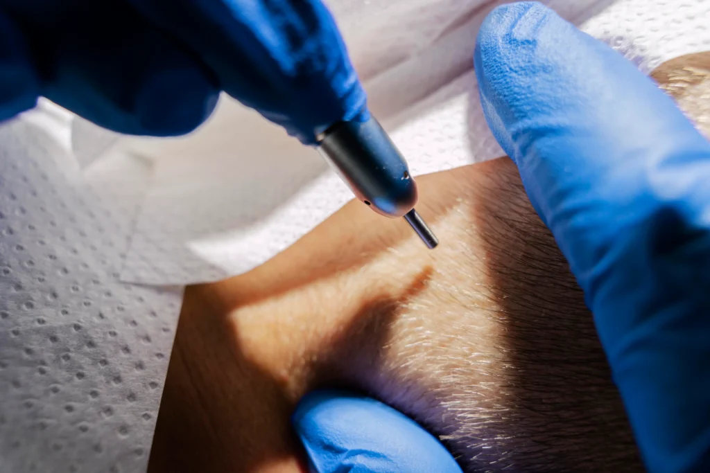 The image shows a close-up of a scalp micropigmentation procedure