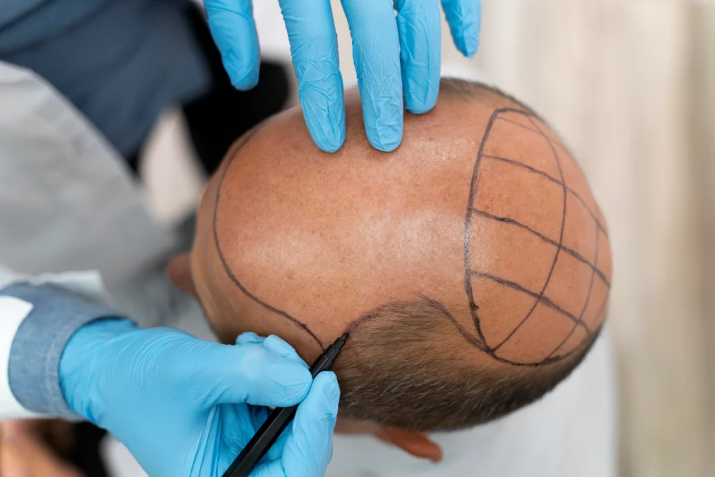 The image shows a close-up of a person's bald head being marked with a grid and hairline outline